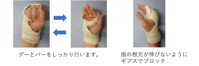 手 指の骨折における非常に有用なギプス法 Kenspo通信 No 17 健康スポーツクリニック メディカルフィットネスfine