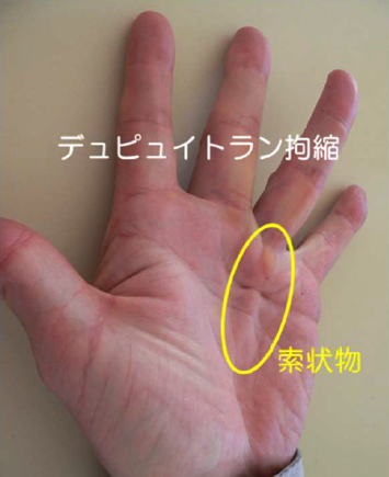 デュピュイトラン拘縮